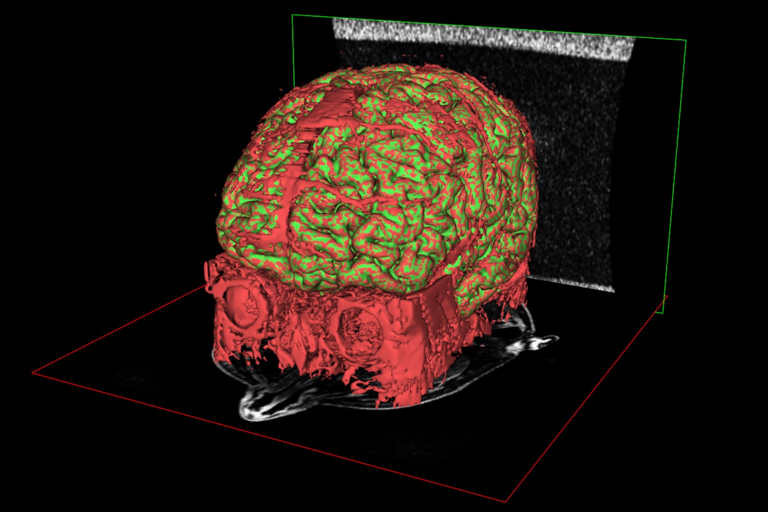 Blood vessels clinging to the surface are highlighted in red, overlaid onto the final model in green.